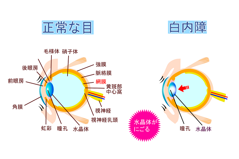 白内障とは