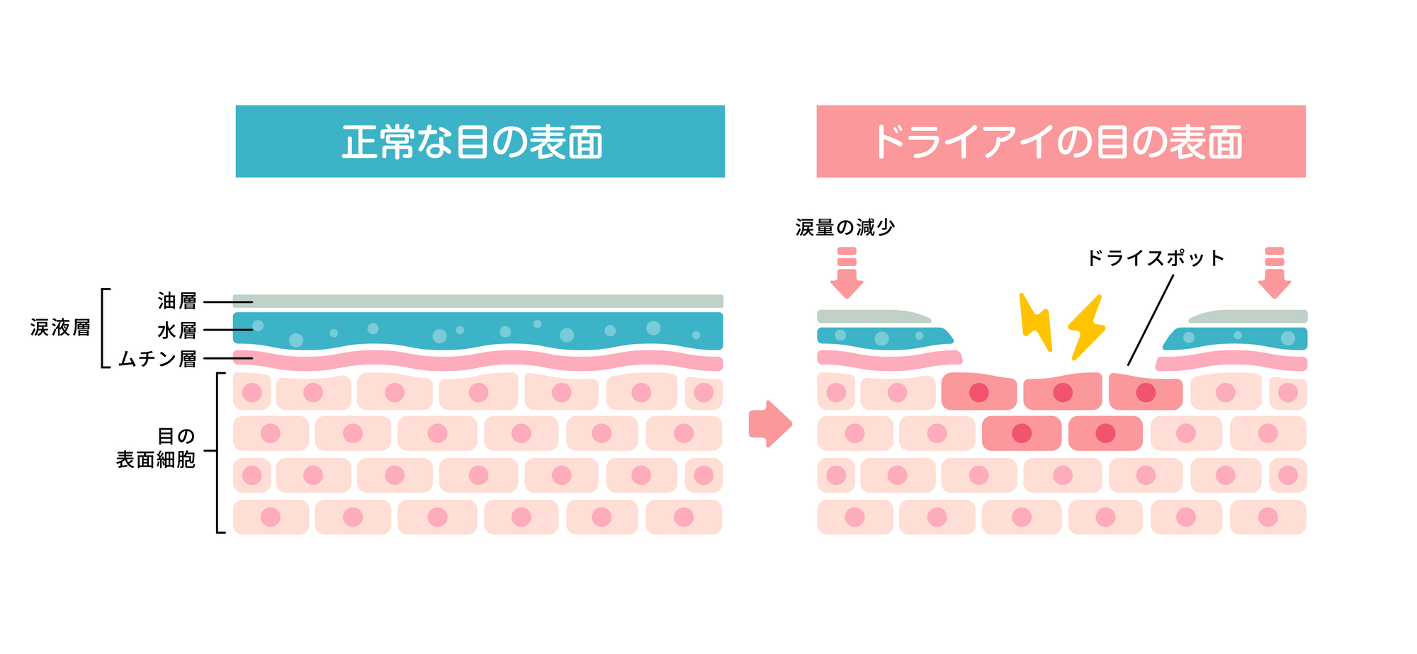 ドライアイとは