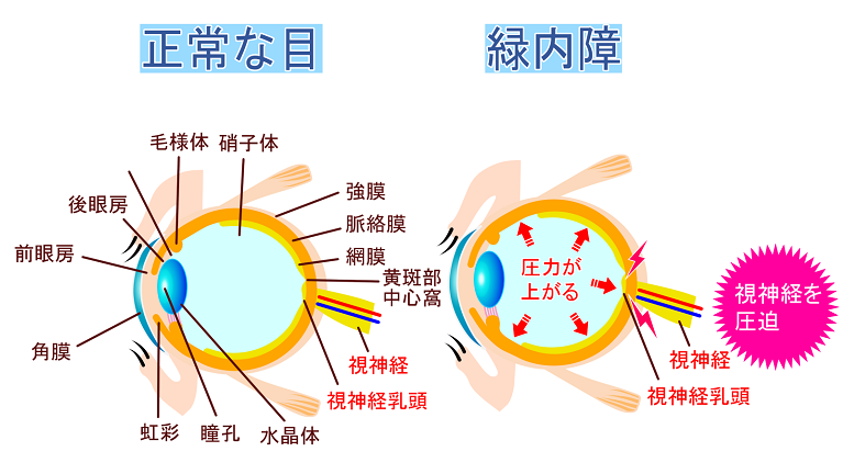 緑内障とは