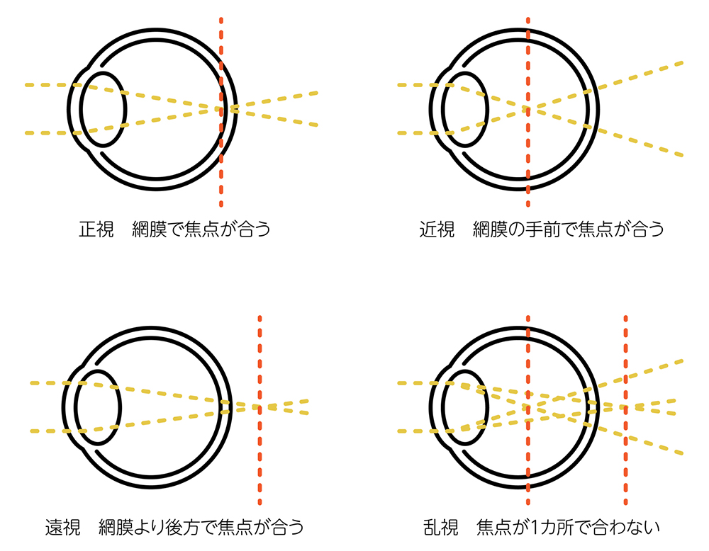 屈折異常とは