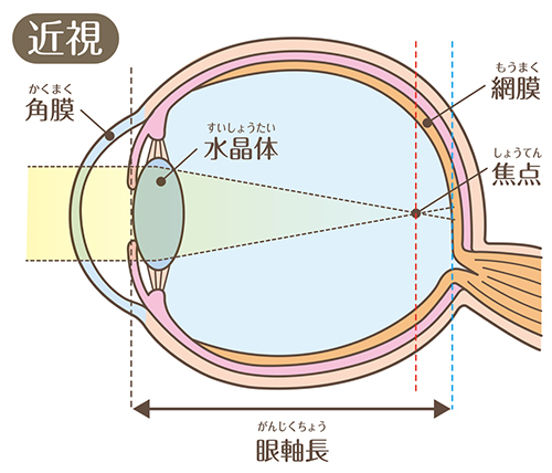 近視の症状（見え方）