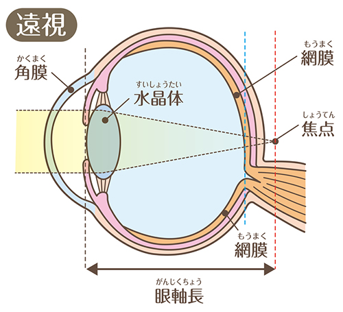 遠視の症状（見え方）