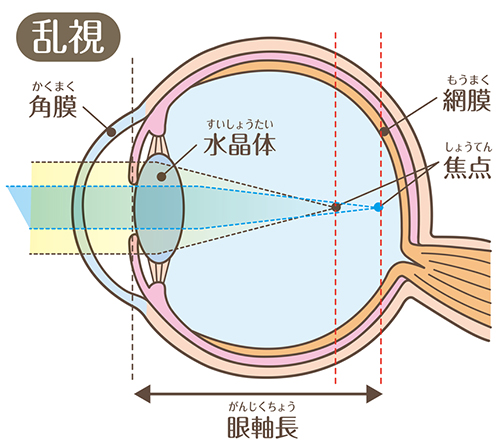 乱視の症状（見え方）