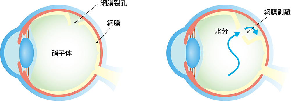 網膜裂孔と網膜剥離の違いは？